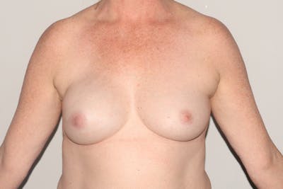 Breast Reconstruction Before & After Gallery - Patient 465722 - Image 2