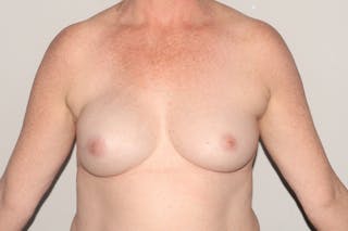 Breast Reconstruction Before & After Gallery - Patient 465722 - Image 2