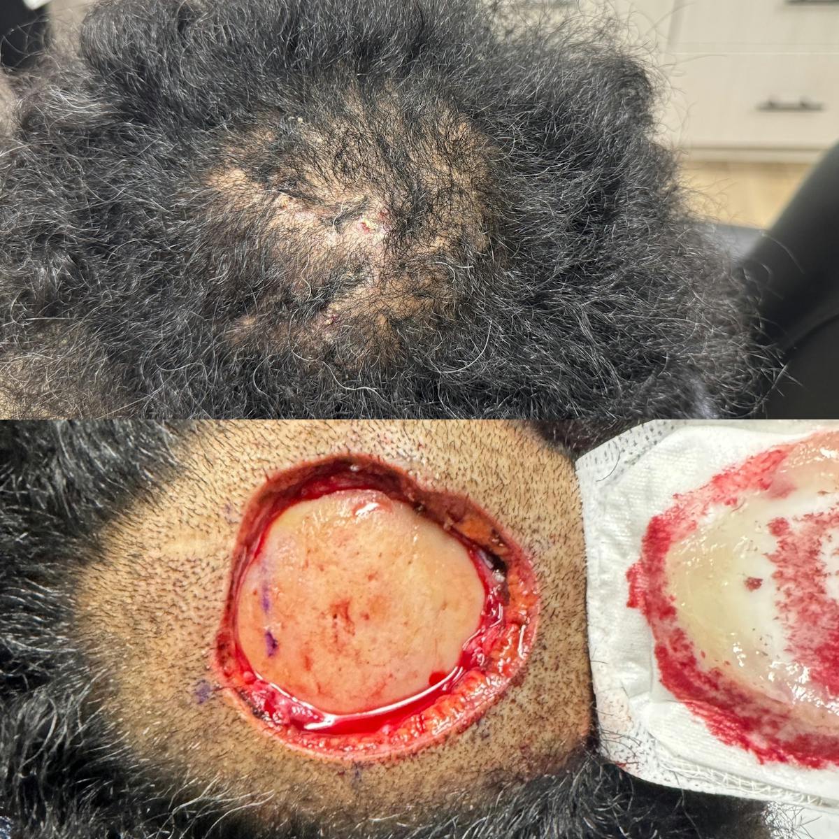 Mohs Facial Reconstruction  Before & After Gallery - Patient 195384 - Image 1