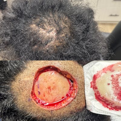 Mohs Facial Reconstruction  Before & After Gallery - Patient 195384 - Image 1