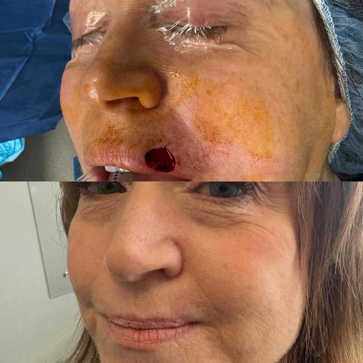 Mohs Facial Reconstruction  Before & After Gallery - Patient 155279 - Image 1