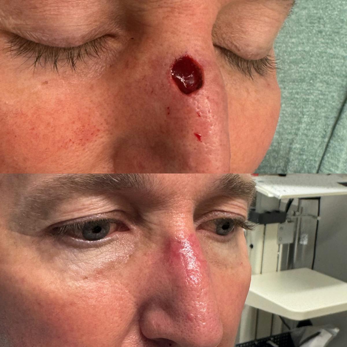Mohs Facial Reconstruction  Before & After Gallery - Patient 118541 - Image 1