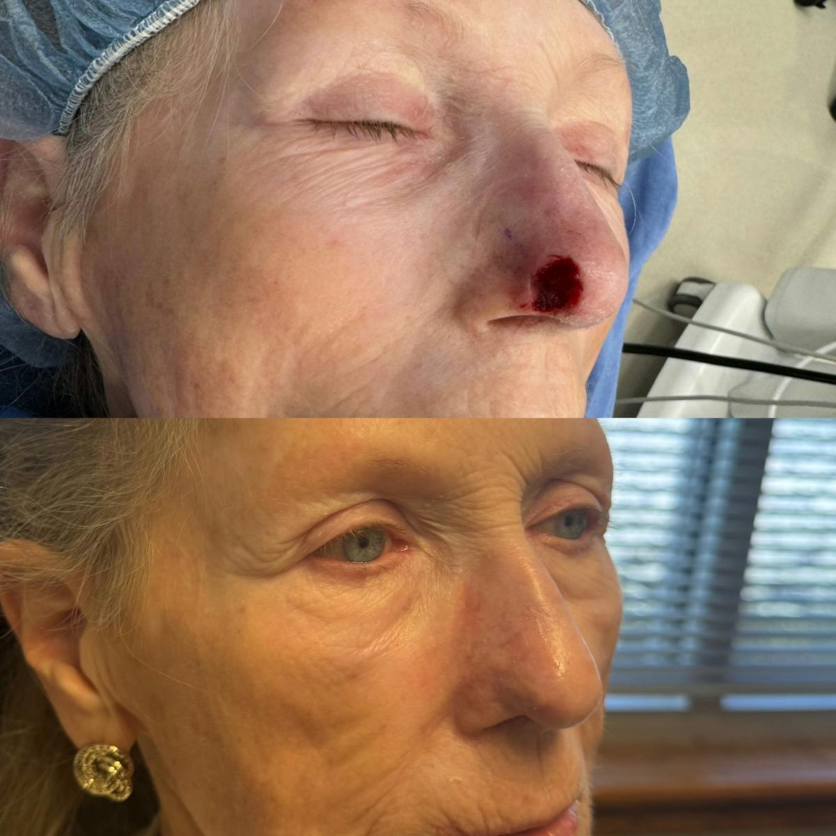 Mohs Facial Reconstruction  Before & After Gallery - Patient 178409 - Image 1