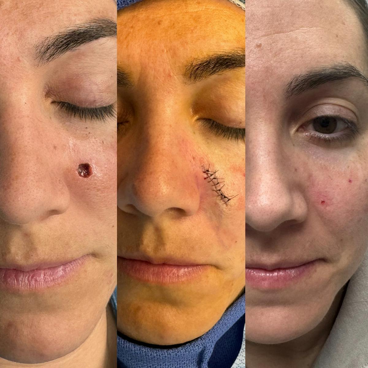 Mohs Facial Reconstruction  Before & After Gallery - Patient 301430 - Image 1