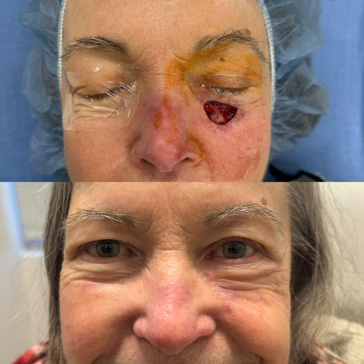 Mohs Facial Reconstruction  Before & After Gallery - Patient 163000 - Image 1