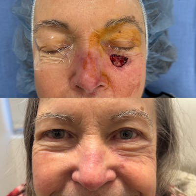 Mohs Facial Reconstruction  Before & After Gallery - Patient 163000 - Image 1
