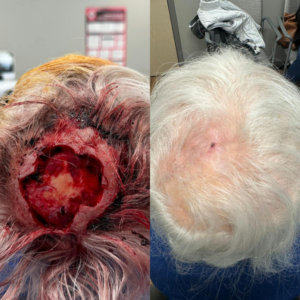 Mohs Facial Reconstruction  Before & After Gallery - Patient 283719 - Image 1