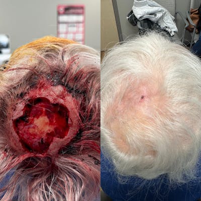 Mohs Facial Reconstruction  Before & After Gallery - Patient 283719 - Image 1