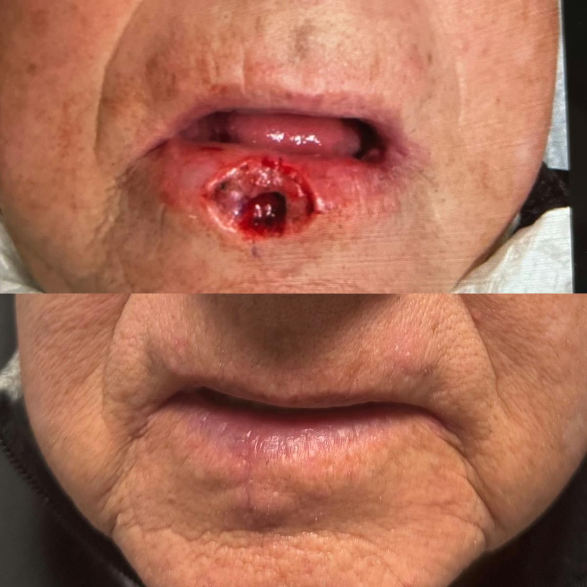 Mohs Facial Reconstruction  Before & After Gallery - Patient 599100 - Image 1