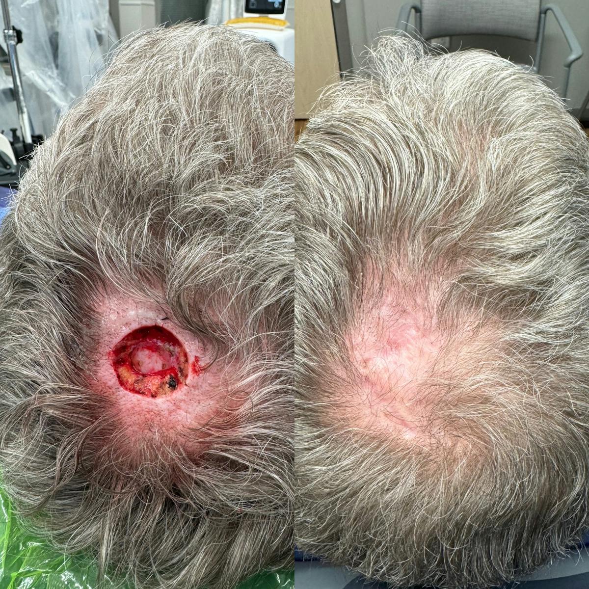 Mohs Facial Reconstruction  Before & After Gallery - Patient 185812 - Image 1