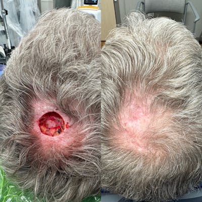 Mohs Facial Reconstruction  Before & After Gallery - Patient 185812 - Image 1