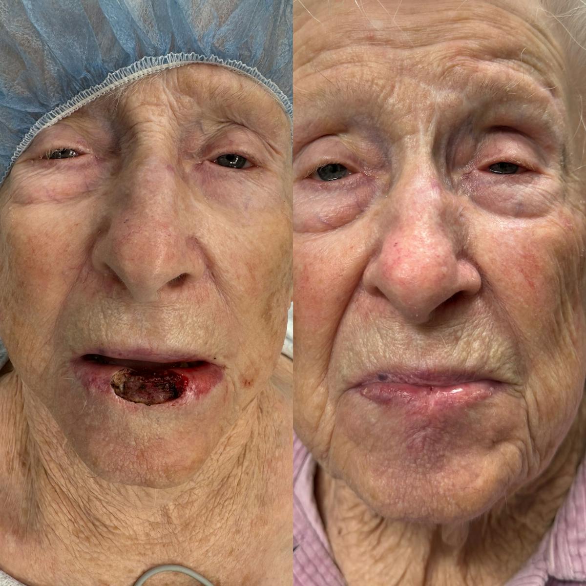 Mohs Facial Reconstruction  Before & After Gallery - Patient 264007 - Image 1
