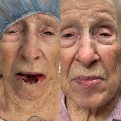 Mohs Facial Reconstruction  Before & After Gallery - Patient 264007 - Image 1
