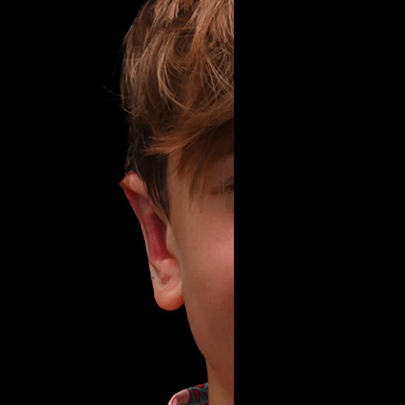 Otoplasty Before & After Gallery - Patient 323152 - Image 8