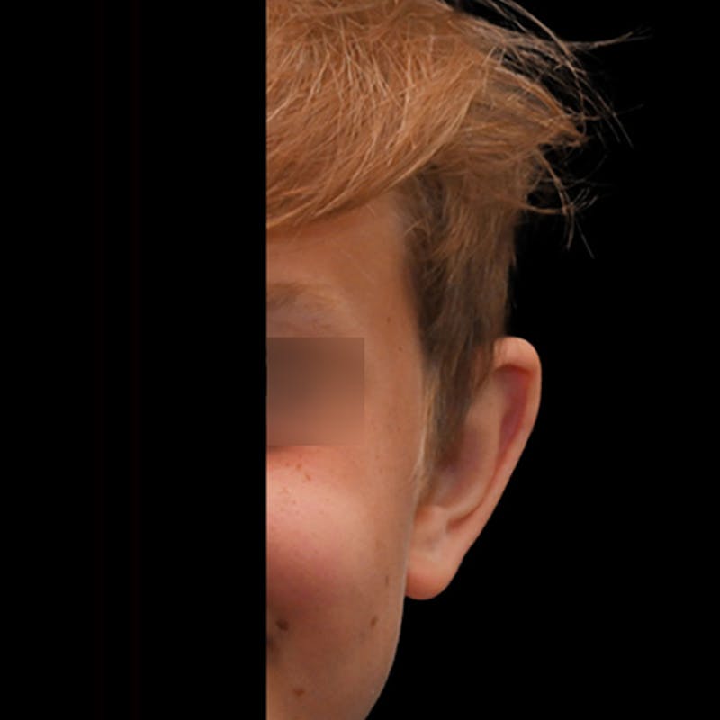 Otoplasty Before & After Gallery - Patient 323152 - Image 5