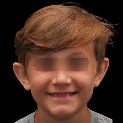 Otoplasty Before & After Gallery - Patient 323152 - Image 1