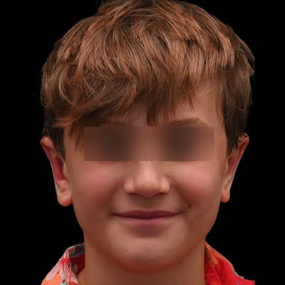 Otoplasty Before & After Gallery - Patient 323152 - Image 2