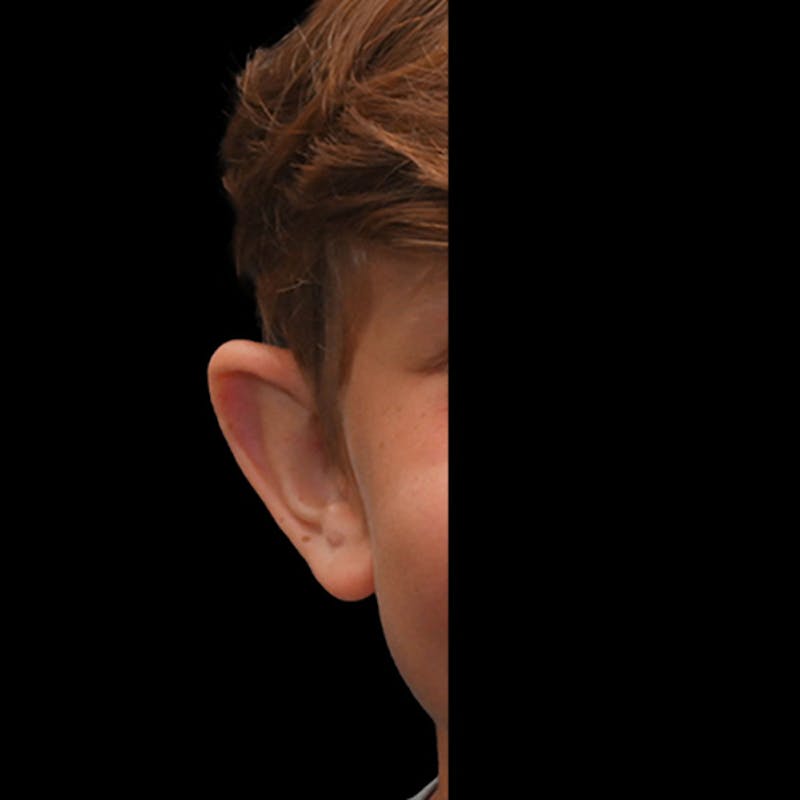 Otoplasty Before & After Gallery - Patient 323152 - Image 7