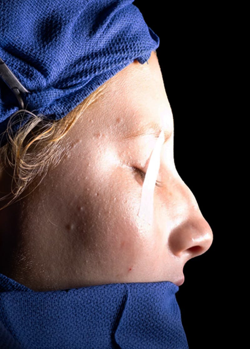 Rhinoplasty Before & After Gallery - Patient 652045 - Image 16