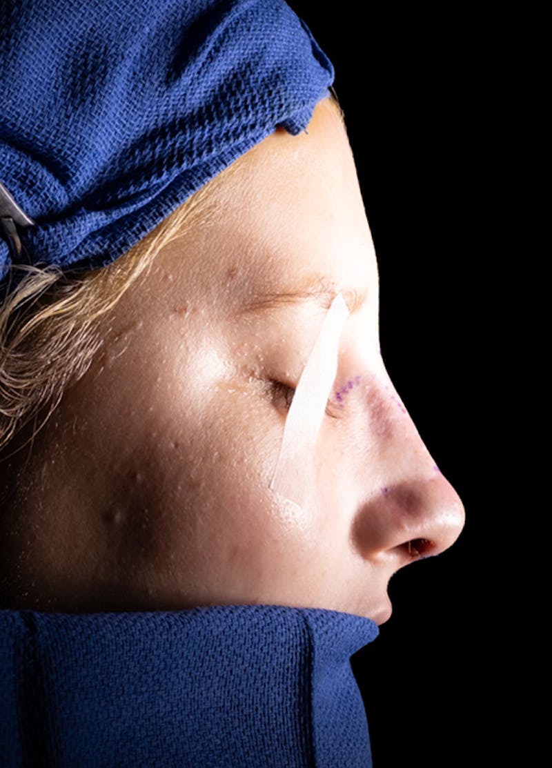 Rhinoplasty Before & After Gallery - Patient 652045 - Image 15