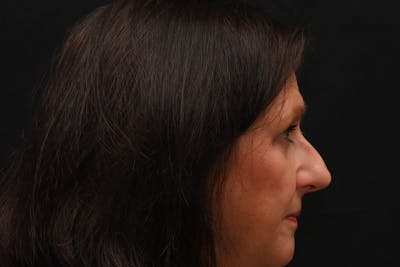 Rhinoplasty Before & After Gallery - Patient 137370 - Image 1