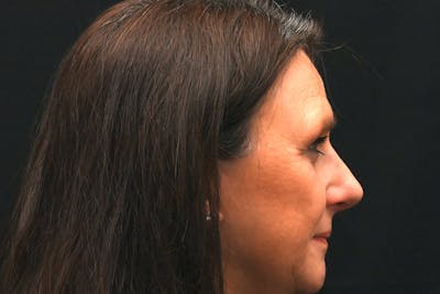 Rhinoplasty Before & After Gallery - Patient 137370 - Image 2