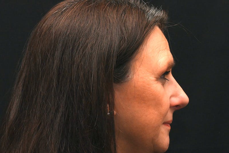 Rhinoplasty Before & After Gallery - Patient 137370 - Image 2