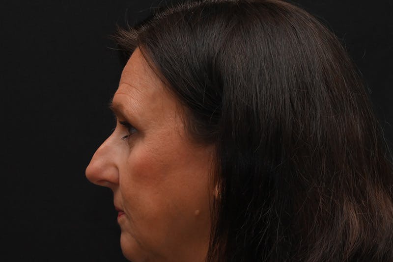 Rhinoplasty Before & After Gallery - Patient 137370 - Image 9
