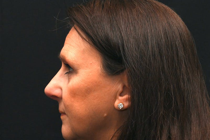 Rhinoplasty Before & After Gallery - Patient 137370 - Image 10