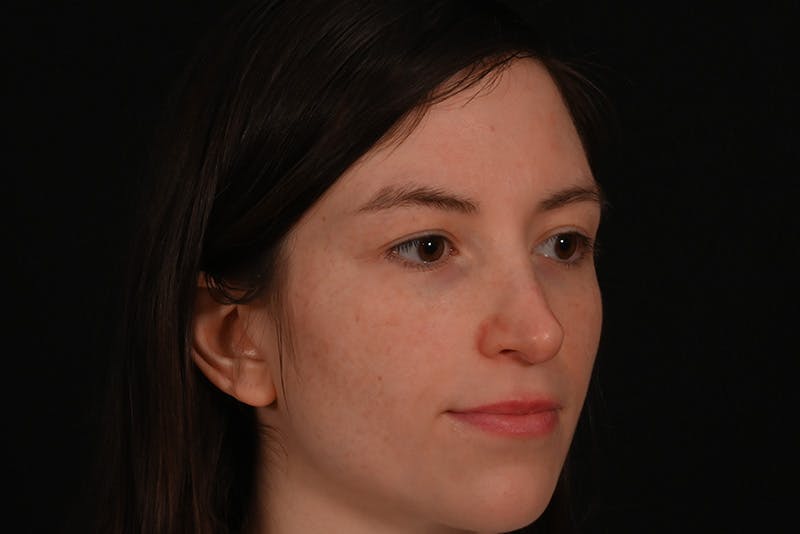 Rhinoplasty Before & After Gallery - Patient 260280 - Image 4