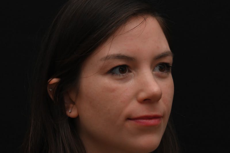 Rhinoplasty Before & After Gallery - Patient 260280 - Image 3