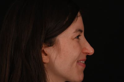 Rhinoplasty Before & After Gallery - Patient 260280 - Image 1