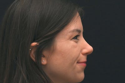 Rhinoplasty Before & After Gallery - Patient 260280 - Image 2