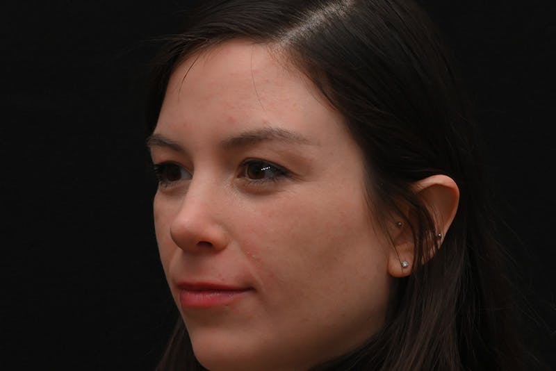 Rhinoplasty Before & After Gallery - Patient 260280 - Image 8