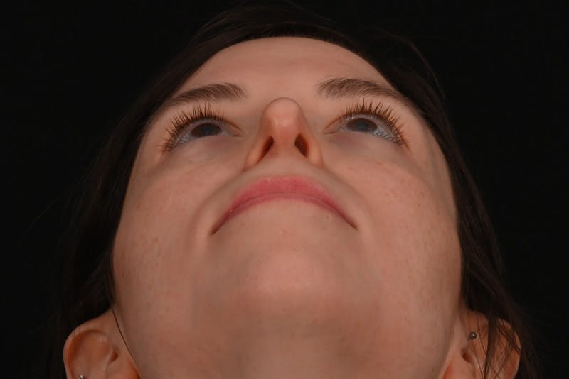 Rhinoplasty Before & After Gallery - Patient 260280 - Image 11