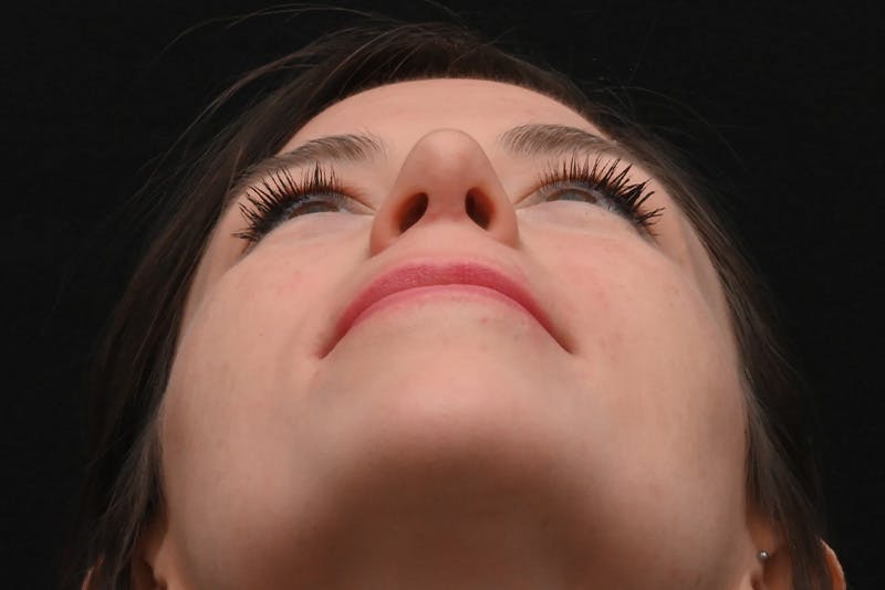 Rhinoplasty Before & After Gallery - Patient 260280 - Image 12