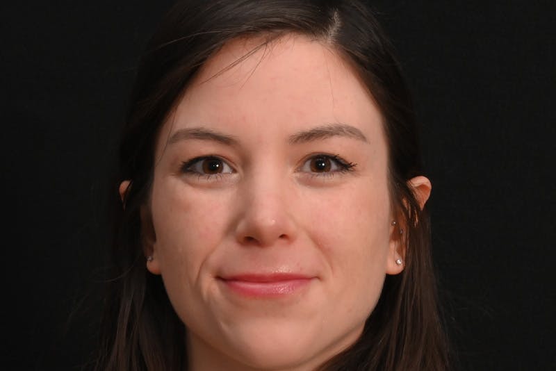 Rhinoplasty Before & After Gallery - Patient 260280 - Image 6