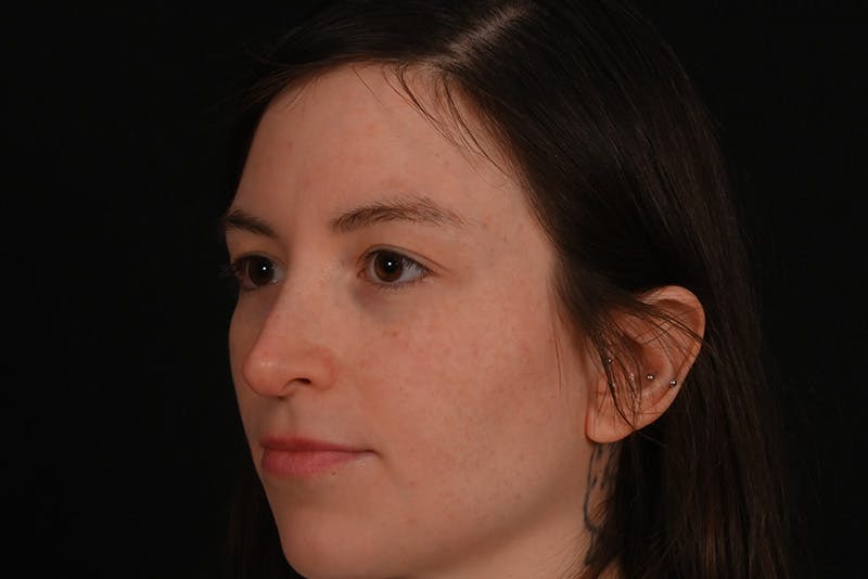 Rhinoplasty Before & After Gallery - Patient 260280 - Image 7