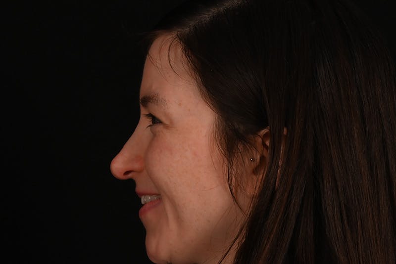 Rhinoplasty Before & After Gallery - Patient 260280 - Image 9