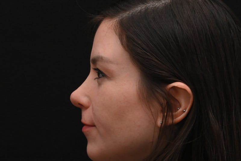 Rhinoplasty Before & After Gallery - Patient 260280 - Image 10