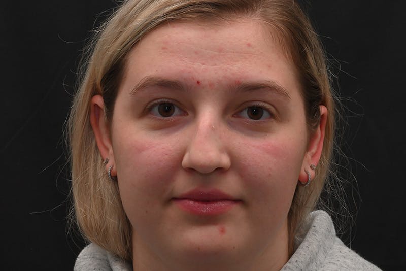 Rhinoplasty Before & After Gallery - Patient 164163 - Image 5
