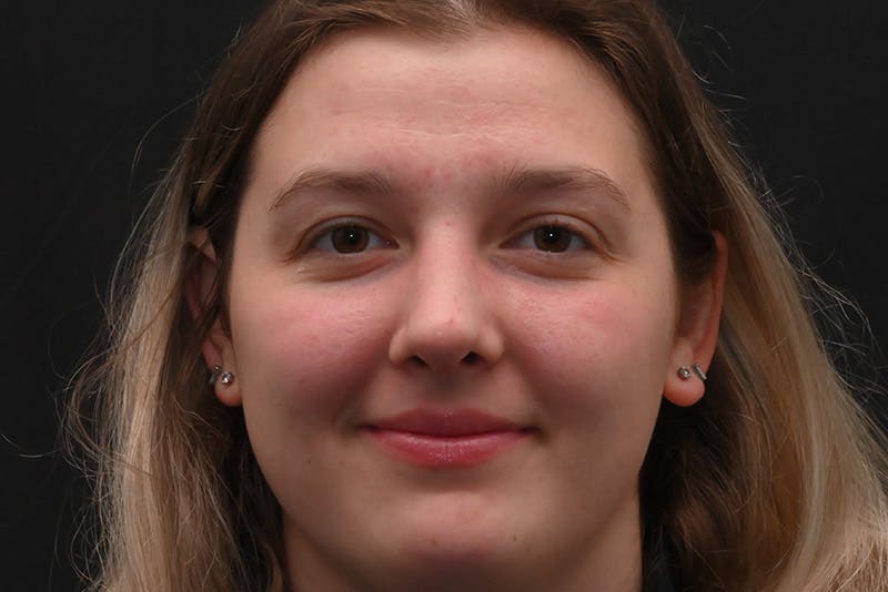 Rhinoplasty Before & After Gallery - Patient 164163 - Image 6