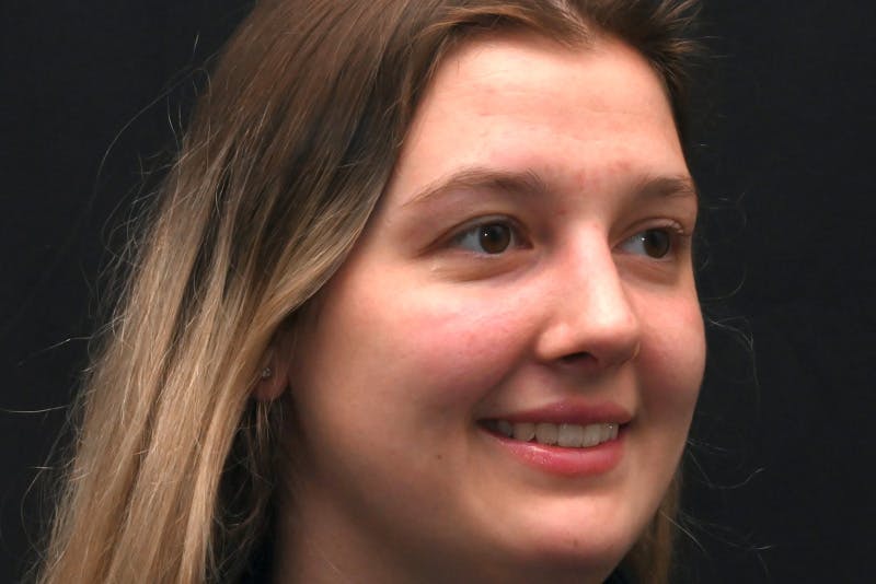 Rhinoplasty Before & After Gallery - Patient 164163 - Image 4