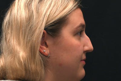 Rhinoplasty Before & After Gallery - Patient 164163 - Image 1