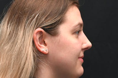 Rhinoplasty Before & After Gallery - Patient 164163 - Image 2