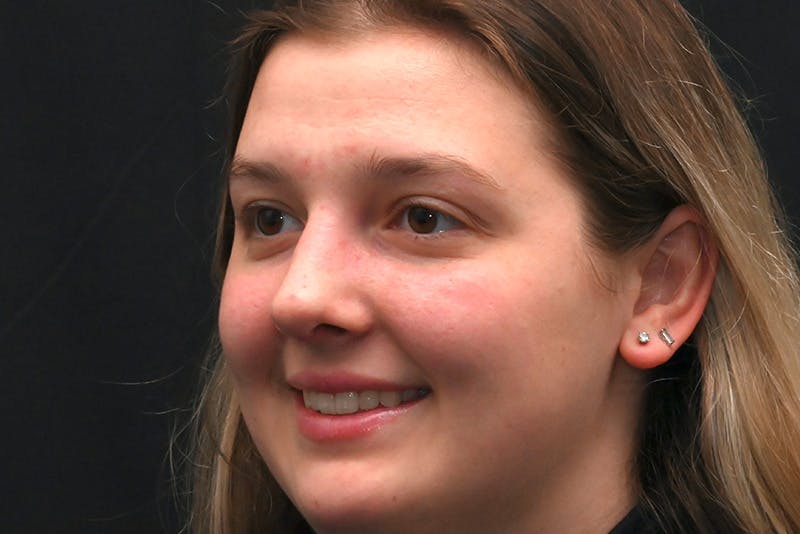 Rhinoplasty Before & After Gallery - Patient 164163 - Image 8