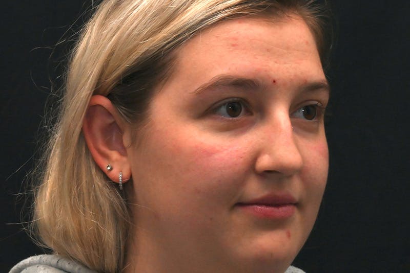 Rhinoplasty Before & After Gallery - Patient 164163 - Image 3