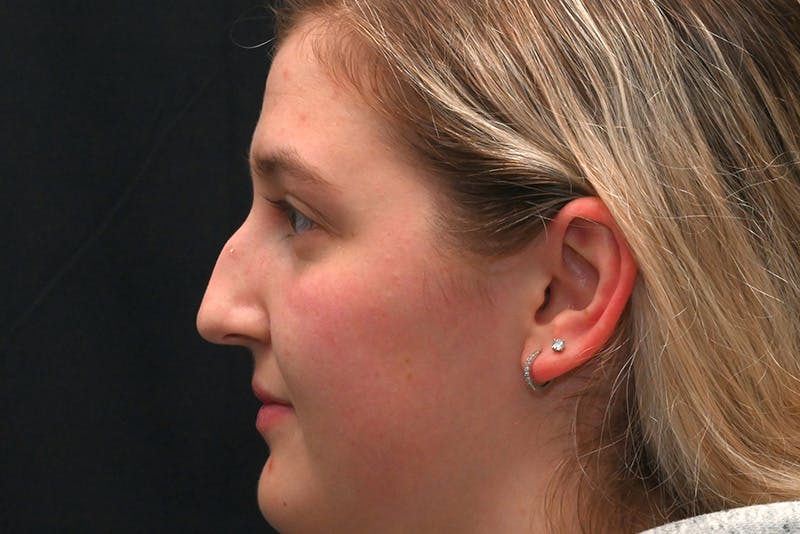 Rhinoplasty Before & After Gallery - Patient 164163 - Image 9