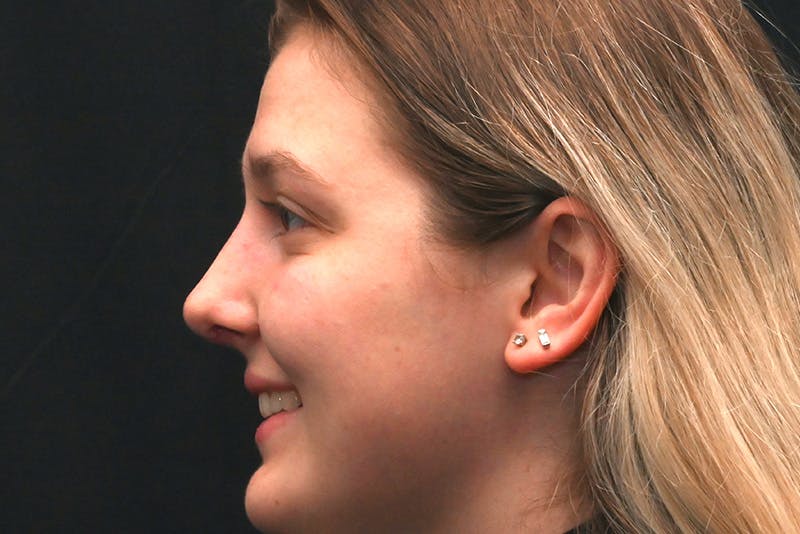 Rhinoplasty Before & After Gallery - Patient 164163 - Image 10