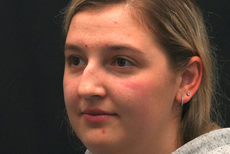 Rhinoplasty Before & After Gallery - Patient 164163 - Image 7